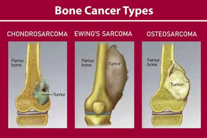 When Liesl Can No Longer Donate Her Bone Marrow — Somebody Else Will, But Who?